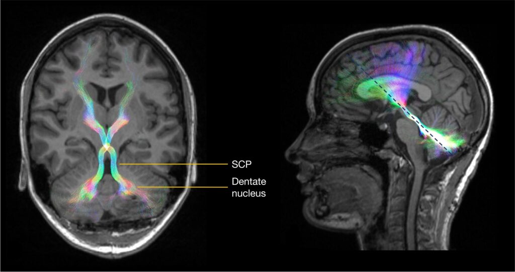 Fig 1 1 - Society for Pediatric Neurosurgical Oncology
