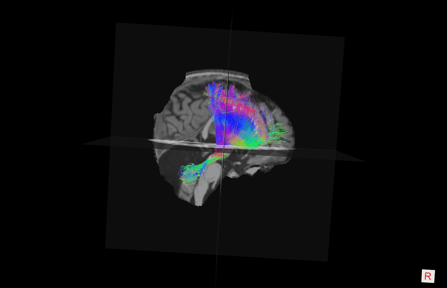 dtct tract - Society for Pediatric Neurosurgical Oncology