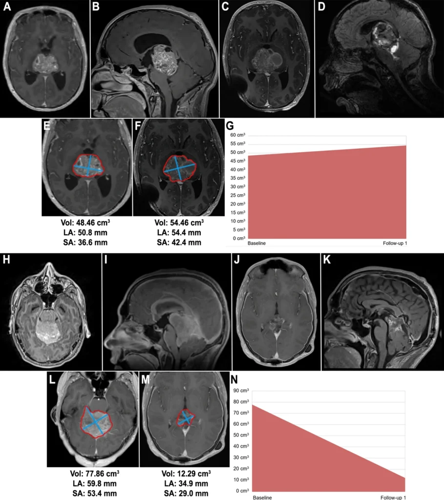 11060 2026 5638 Fig2 HTML - Society for Pediatric Neurosurgical Oncology